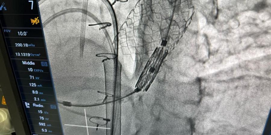 الصحة تعلن نجاح عملية دقيقة لتغيير الصمام الرئوي بالقسطرة في أكاديمية قلب المبرة